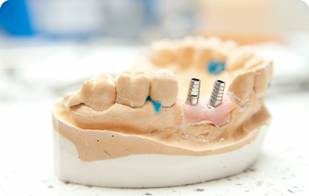 Greffe osseuse & Sinus lift Dentistes à Camblanes-et-Meynac, Cab﻿inet dentaire des Vignes