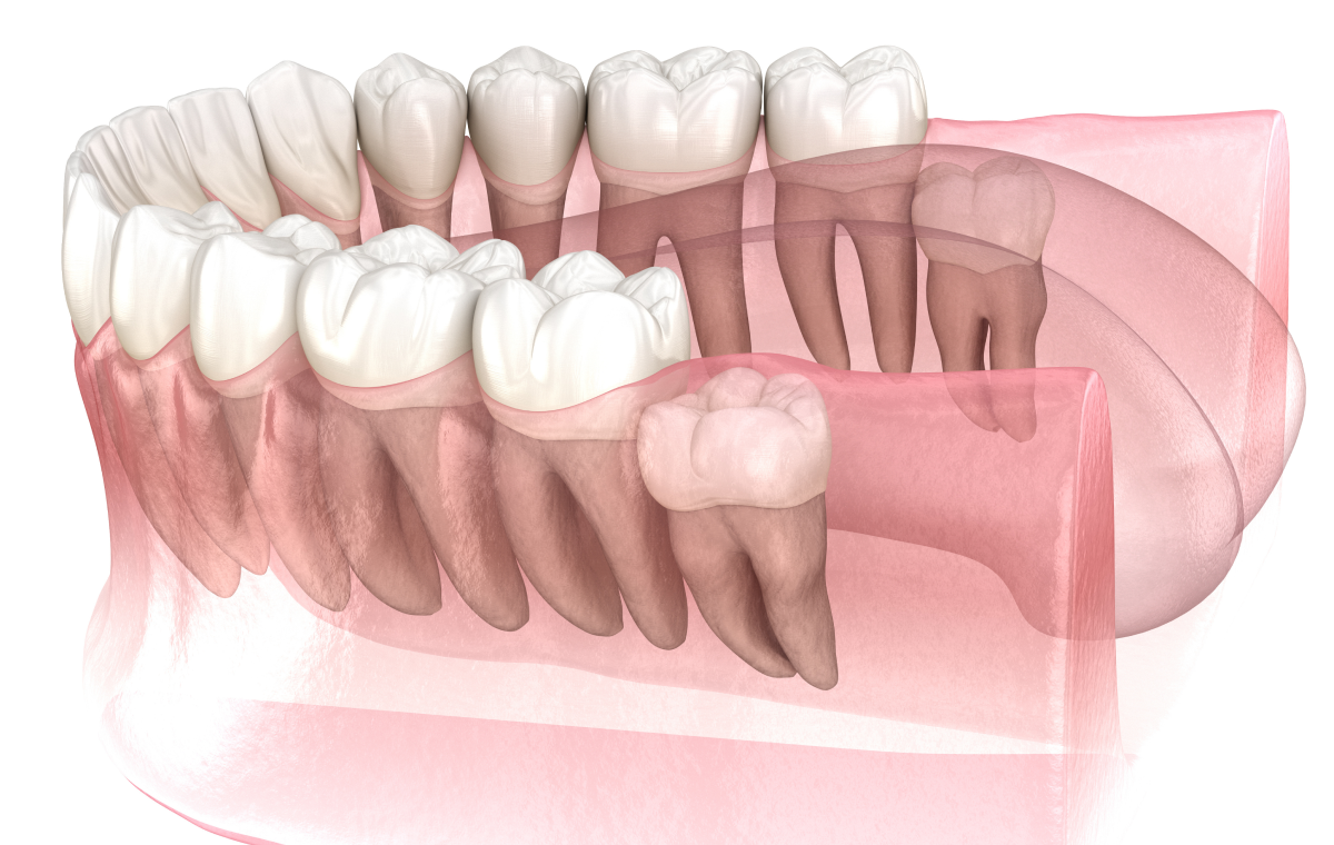 Extraction des dents de sagesse Dentistes à Camblanes-et-Meynac, Cab﻿inet dentaire des Vignes