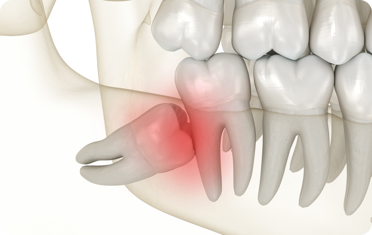 Extraction des dents de sagesse Dentistes à Camblanes-et-Meynac, Cab﻿inet dentaire des Vignes