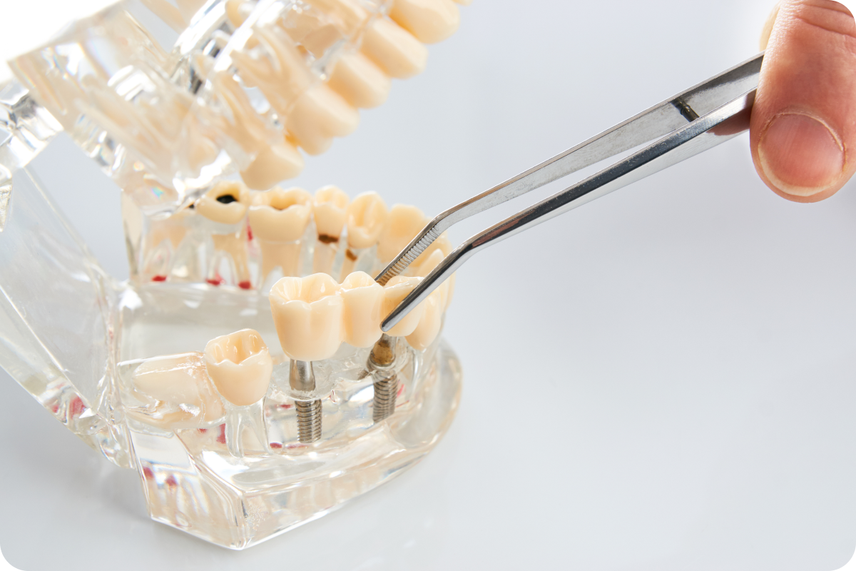 Implant dentaire Dentistes à Camblanes-et-Meynac, Cab﻿inet dentaire des Vignes
