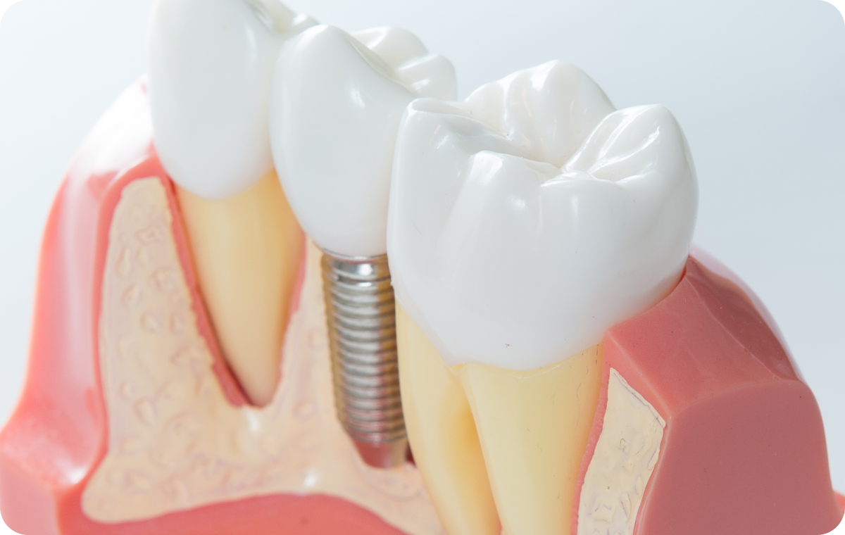 Implant dentaire Dentistes à Camblanes-et-Meynac, Cab﻿inet dentaire des Vignes