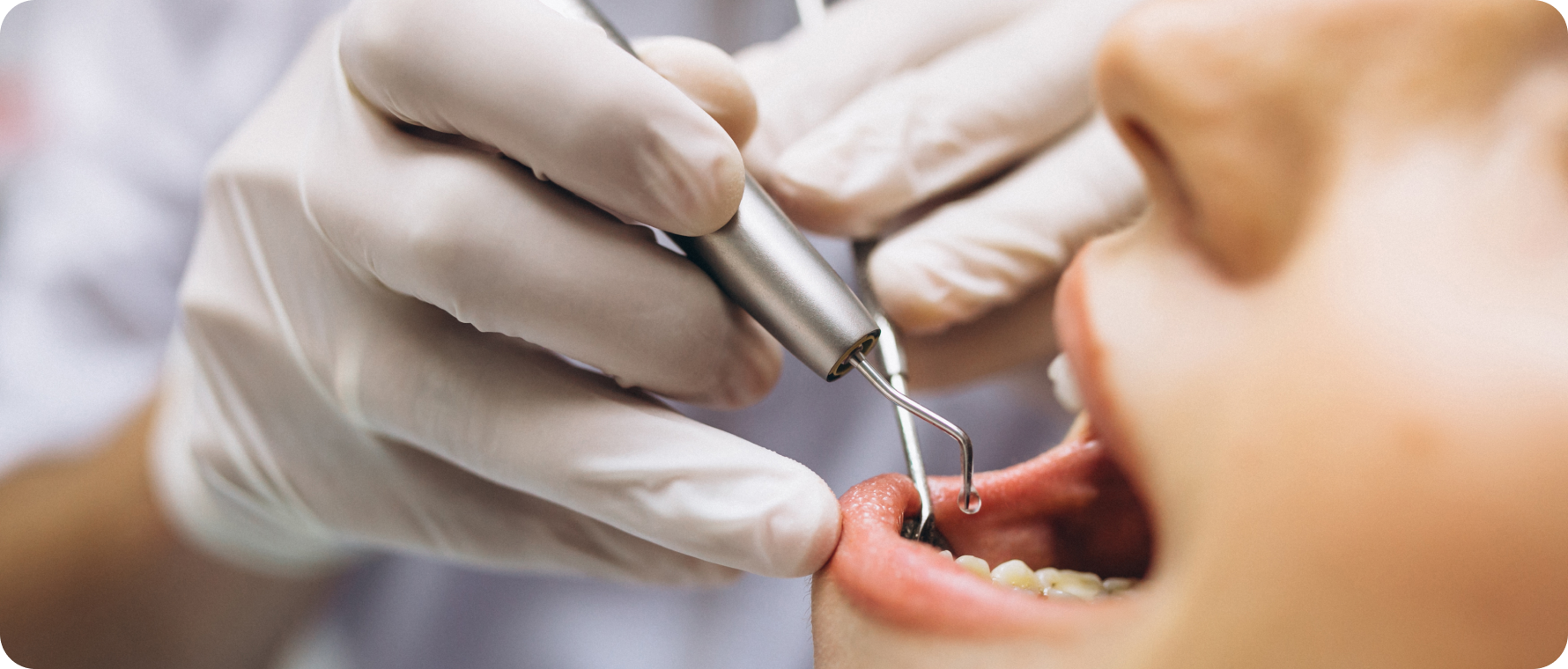 Greffe gingivale Dentistes à Camblanes-et-Meynac, Cab﻿inet dentaire des Vignes