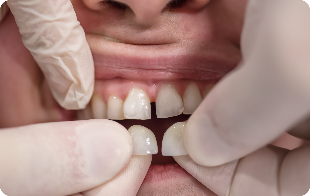 Facettes dentaires Dentistes à Camblanes-et-Meynac, Cab﻿inet dentaire des Vignes