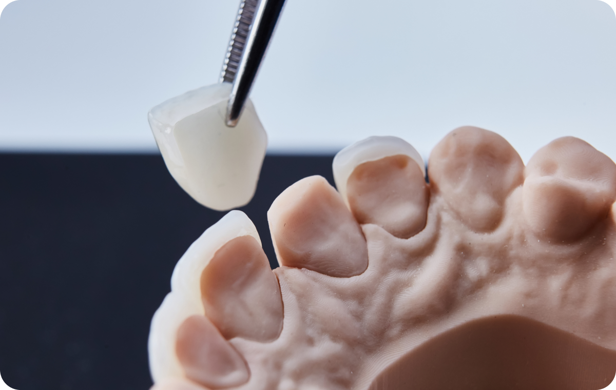 Facettes dentaires Dentistes à Camblanes-et-Meynac, Cab﻿inet dentaire des Vignes