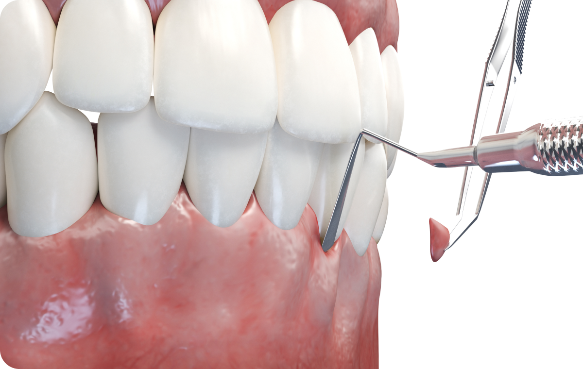 Greffe gingivale Dentistes à Camblanes-et-Meynac, Cab﻿inet dentaire des Vignes