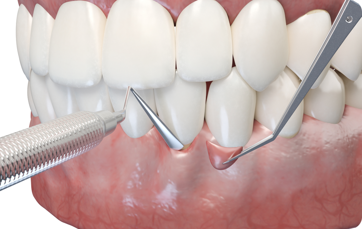 Greffe gingivale Dentistes à Camblanes-et-Meynac, Cab﻿inet dentaire des Vignes