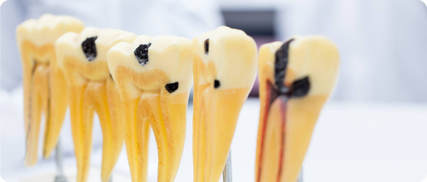 Soins des caries de l’enfant Dentistes à Camblanes-et-Meynac, Cab﻿inet dentaire des Vignes